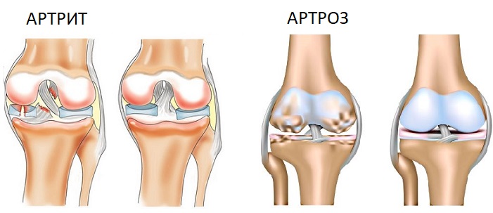 Остеоартроз и артрит вызывают боли в ногах