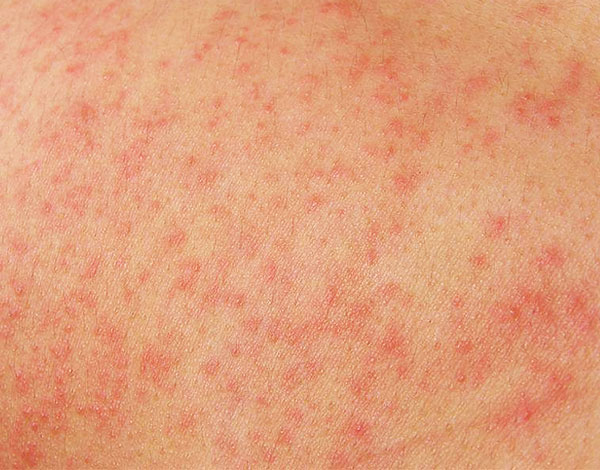Аллергия может возникнуть на любой компонент смеси настоек.